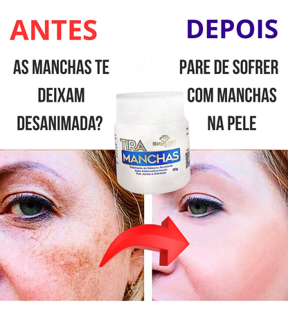 Allucream - Creme clareador de manchas [melasma & escurecimento da pele]  COMPRE 1 LEVE 2
