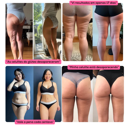 AlluShape 2.0 - Potente redutor de Gordura Localizada, Celulite e Lipedema.